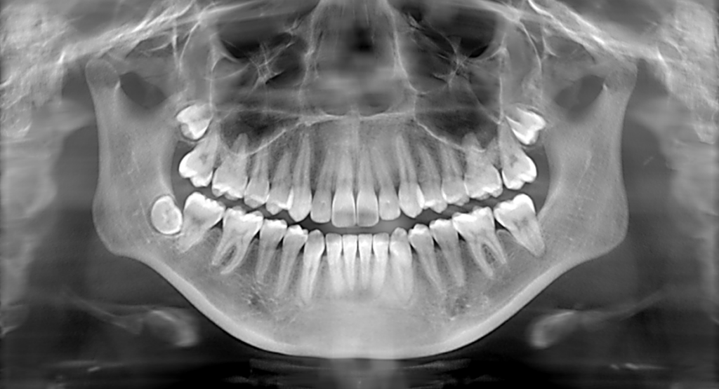 X-Rays Dental